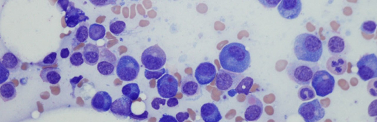 Miyelomda anito-cel CAR-T’te yüzde 100 yanıt: NEJM’den ilk veriler