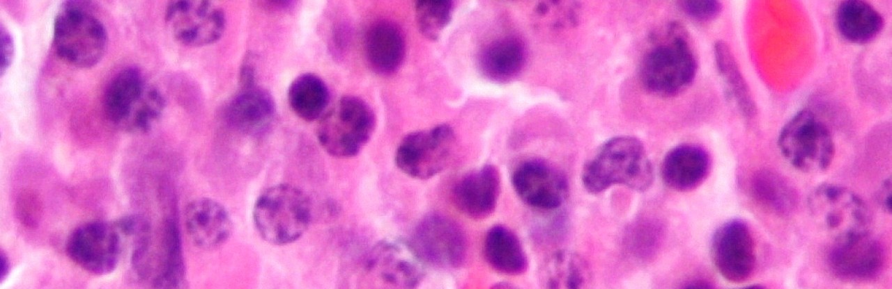 Miyelomda kemik ağrısına düşük doz radyoterapi: Yüzde 82 rahatlama