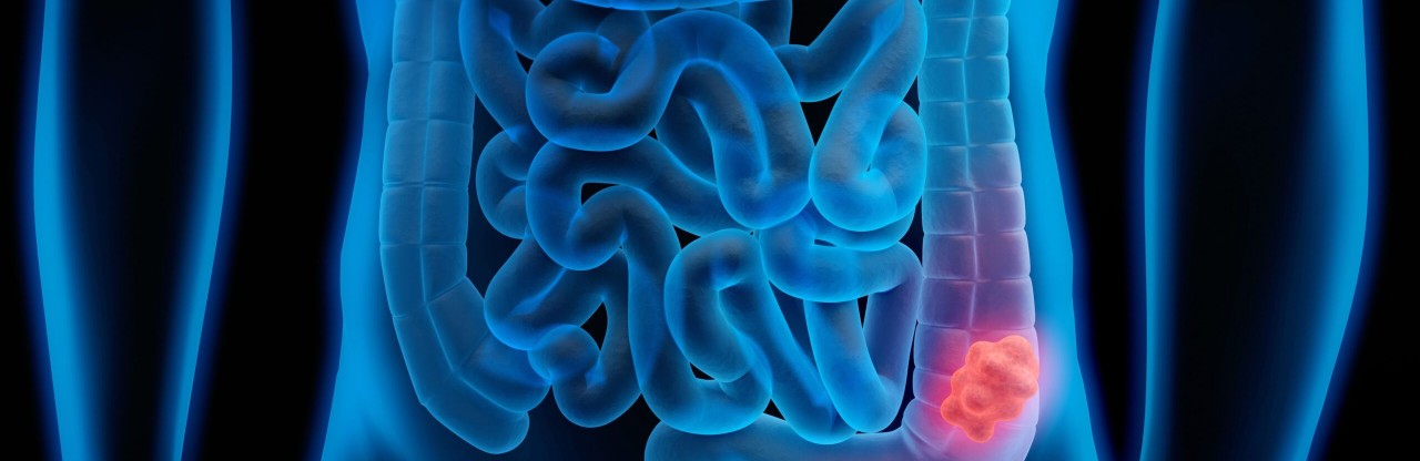 Robotik kolonoskopi FDA onayı aldı: Kolon kanseri taramasında devrim