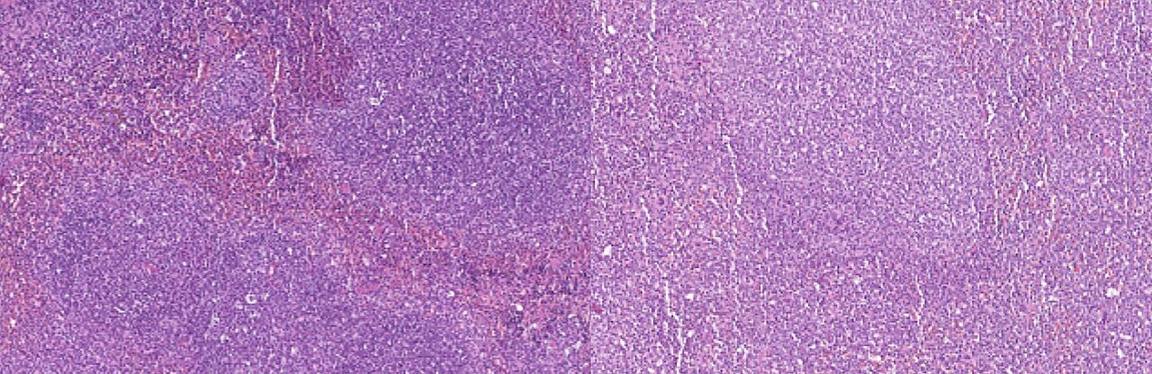 Akut miyeloid lösemide 6 genlik skor: PHFScore hayatta kalma tahmini