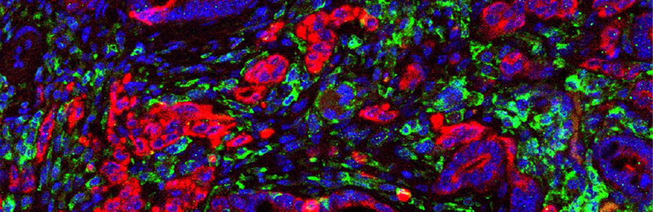 PPARD Proteini Kanserle Mücadelede Bağışıklık Güçleniyor