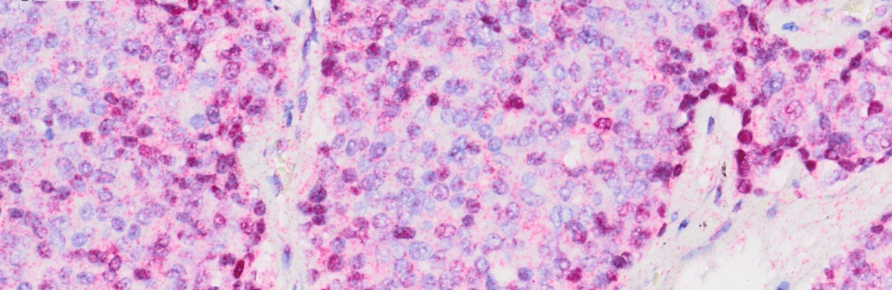 Prostat Kanseri Direncini Tek Molekül Çözüyor: tRNA Keşfi