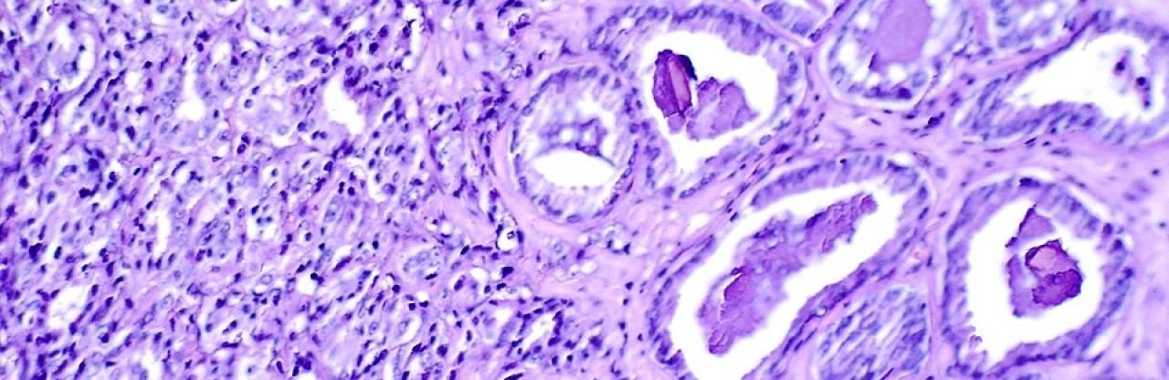 Prostat kanserinde yeni umut: JNJ-6143 erken denemede tumorleri kuculttu