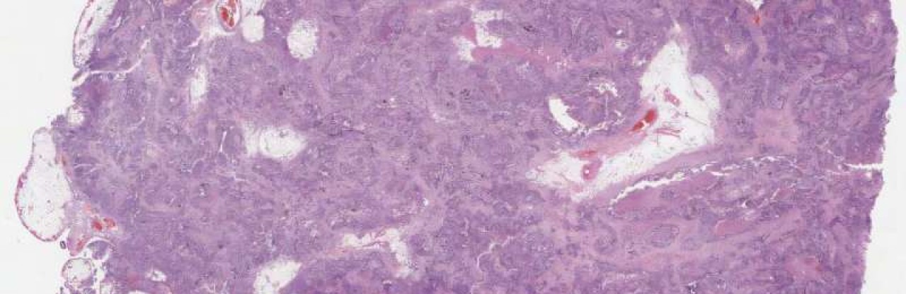 Yumurtalık Kanserinde AI Atılımı: HRDPath DNA Onarım Kusurunu Saptadı
