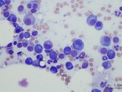 Miyelomda anito-cel CAR-T’te yüzde 100 yanıt: NEJM’den ilk veriler