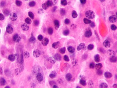 Miyelomda kemik ağrısına düşük doz radyoterapi: Yüzde 82 rahatlama