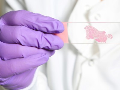 Patolog gibi düşünen yapay zekâ: Kanser metastazını kaçırmıyor