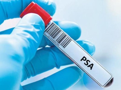 Prostat Kanserinde Aile Öyküsü ve PSA Testi Hayat Kurtarıyor