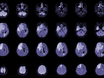 CAR-T hücre tedavisi glioblastoma umudu: Tümörler küçülüyor