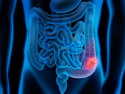 Robotik kolonoskopi FDA onayı aldı: Kolon kanseri taramasında devrim