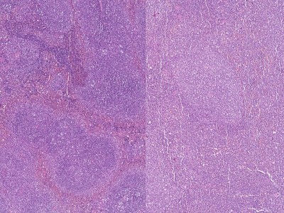 Akut miyeloid lösemide 6 genlik skor: PHFScore hayatta kalma tahmini