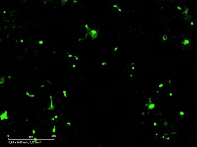 CAR-T hücrelerinde genetik anahtar: Tümör yokkende kapanıyor