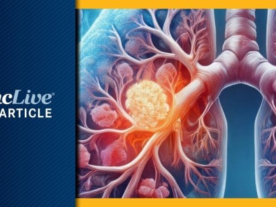 Firmonertinib akciğer kanseri denemesi başarısız: Hisse çakıldı