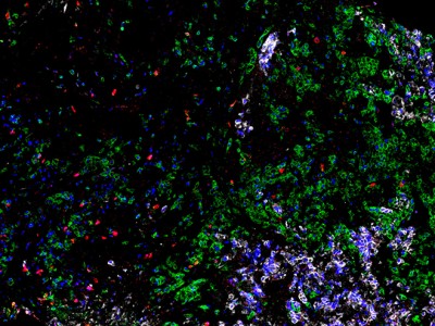 Küçük Hücreli Akciğer Kanserinde Gamma Delta T Hücresi Keşfi