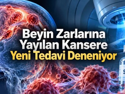 Leptomeningeal Metastazda SX-682 ile Radyoterapi Direnci Aşılıyor