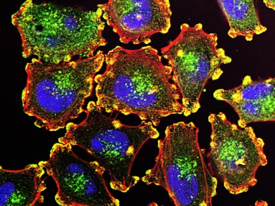 mRNA Kanser Aşısı Melanomda Nüks Riskini Azaltıyor: Faz 3 Sonuçları