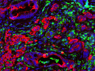 PPARD Proteini Kanserle Mücadelede Bağışıklık Güçleniyor