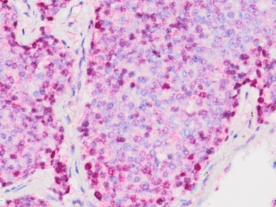 Prostat kanserinde tRNA sırrı: Tedavi direncini tersine çeviren keşif