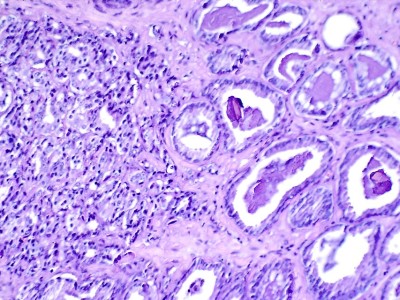 Prostat kanserinde yeni umut: JNJ-6143 erken denemede tumorleri kuculttu