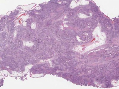 Yumurtalık Kanserinde AI Atılımı: HRDPath DNA Onarım Kusurunu Saptadı