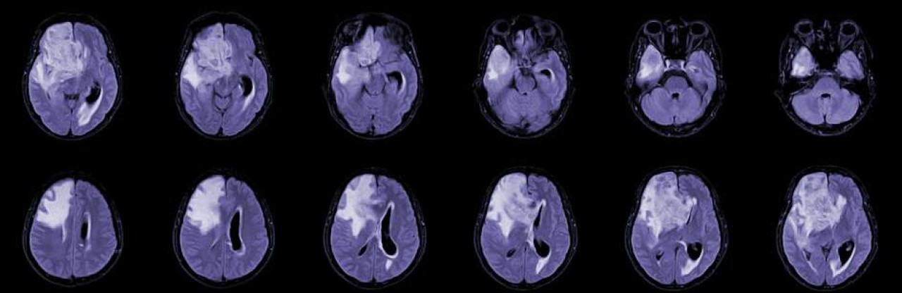 CAR-T hücre tedavisi glioblastoma umudu: Tümörler küçülüyor