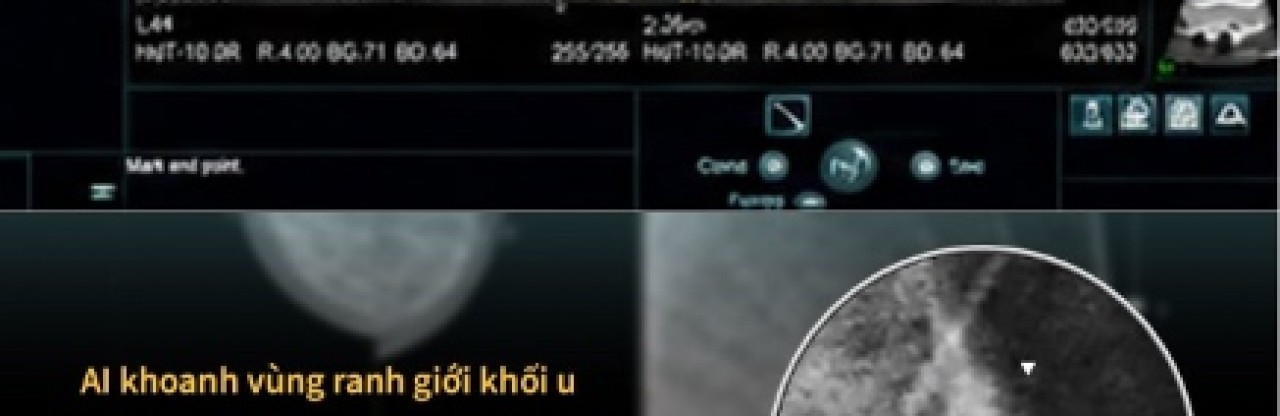 Belirti vermeyen meme kanseri taramada yakalandı: 7 mm’lik tümör şaşırttı