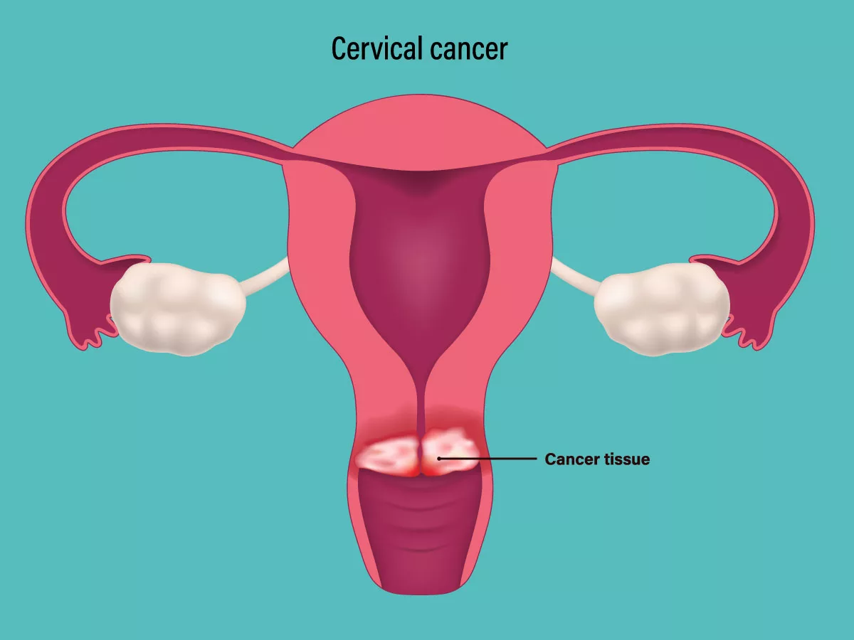 İntradermal mRNA-LNP immünoterapisi HPV-16+ servikal lezyonları hedefler