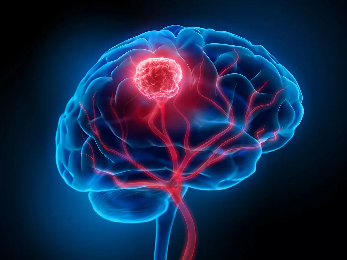 Glioblastoma tedavisinde PRMT5 inhibitörleri — beyin tümörü illüstrasyonu
