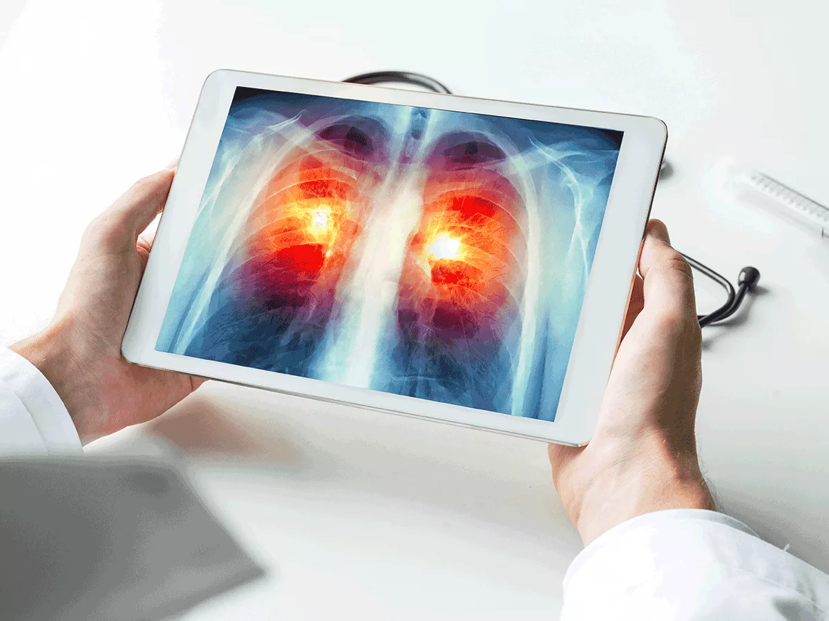 Akciğer kanseri tedavisinde Jideytro klinik çalışması