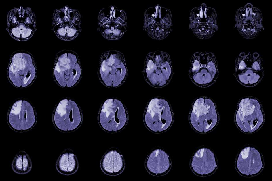 CAR-T hücre tedavisi glioblastoma umudu: Tümörler küçülüyor
