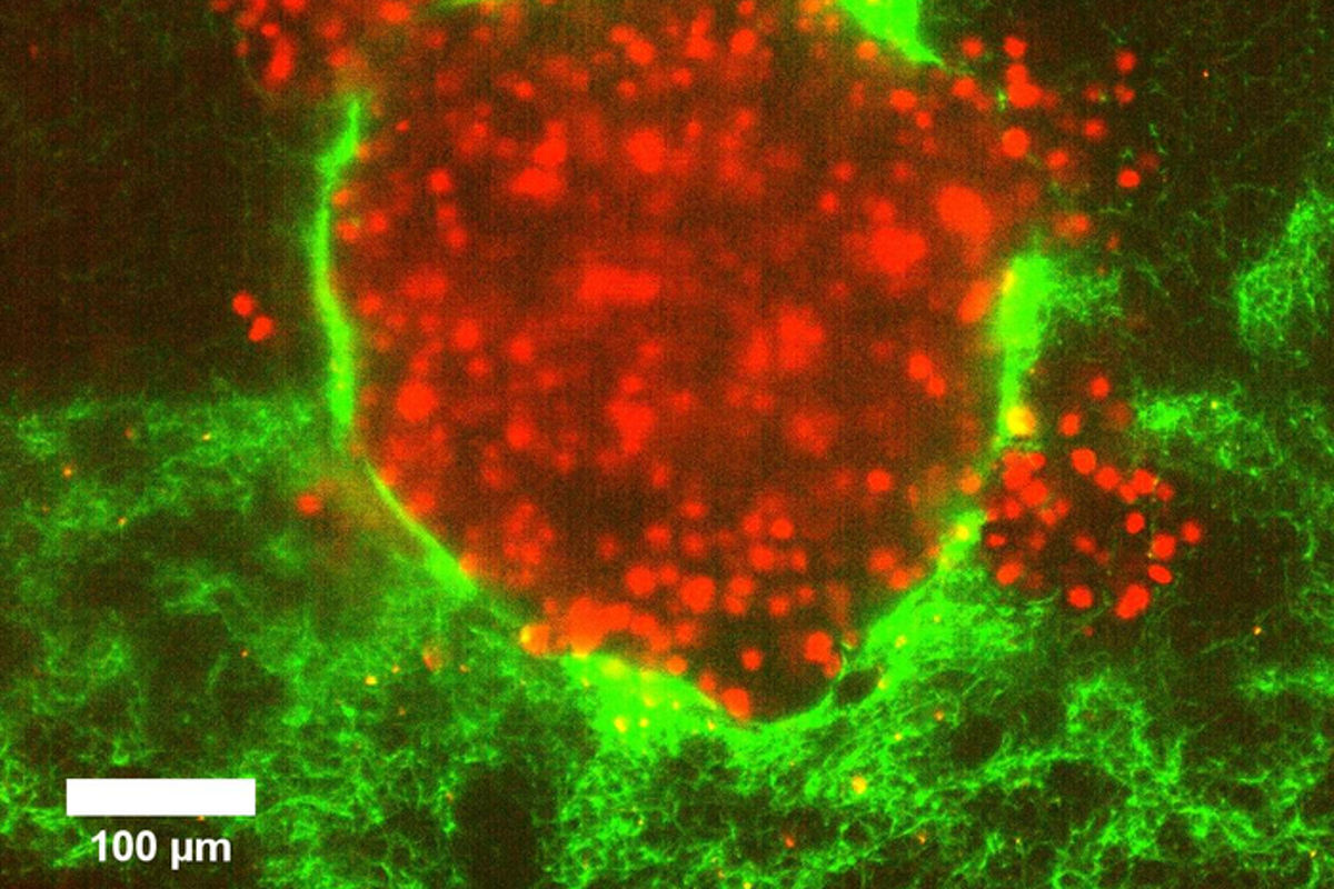 Kanser hücrelerinin mikroskop altında görünümü — küçük tetraploid hücreler daha agresif