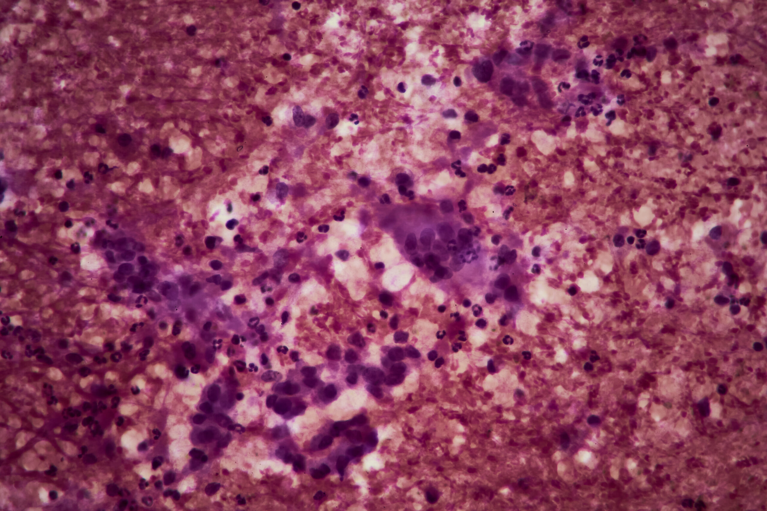 Pankreas kanserinde PRMT5 ve RAS inhibitörü kombinasyon tedavisi